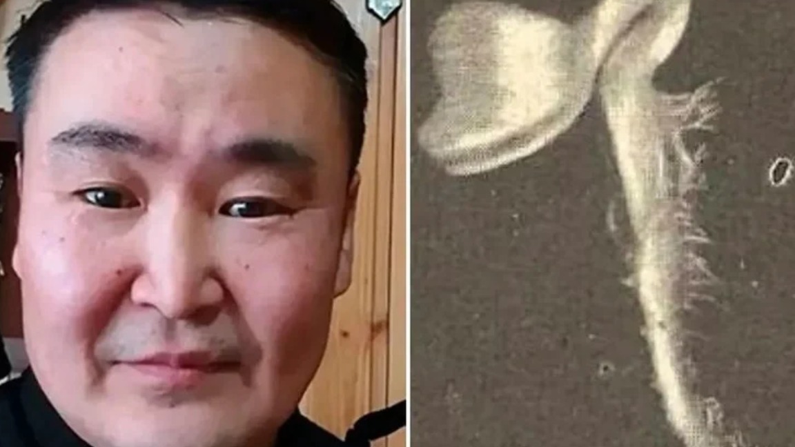 Após pescaria, homem descobre planta crescendo no olho